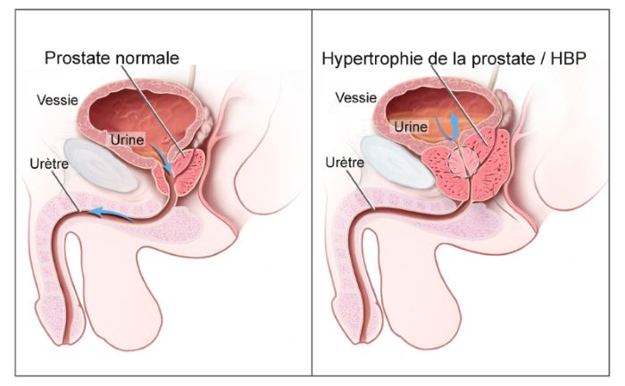 Hypertrophie de la prostate - Laboratoire Naturoscience