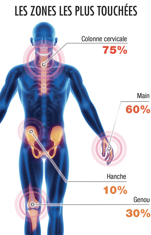 arthrorcure
