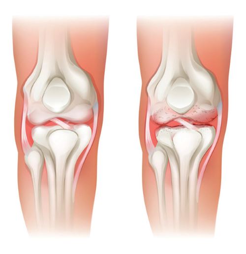 article sur l'arthrose du genoux - Laboratoire Naturoscience