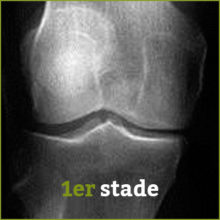 stade1 arthrose - Laboratoire Naturoscience