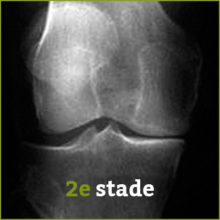 stade 2 arthrose - Laboratoire Naturoscience