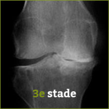 stade 3 arthrose - Laboratoire Naturoscience