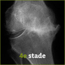 stade4 arthrose - Laboratoire Naturoscience